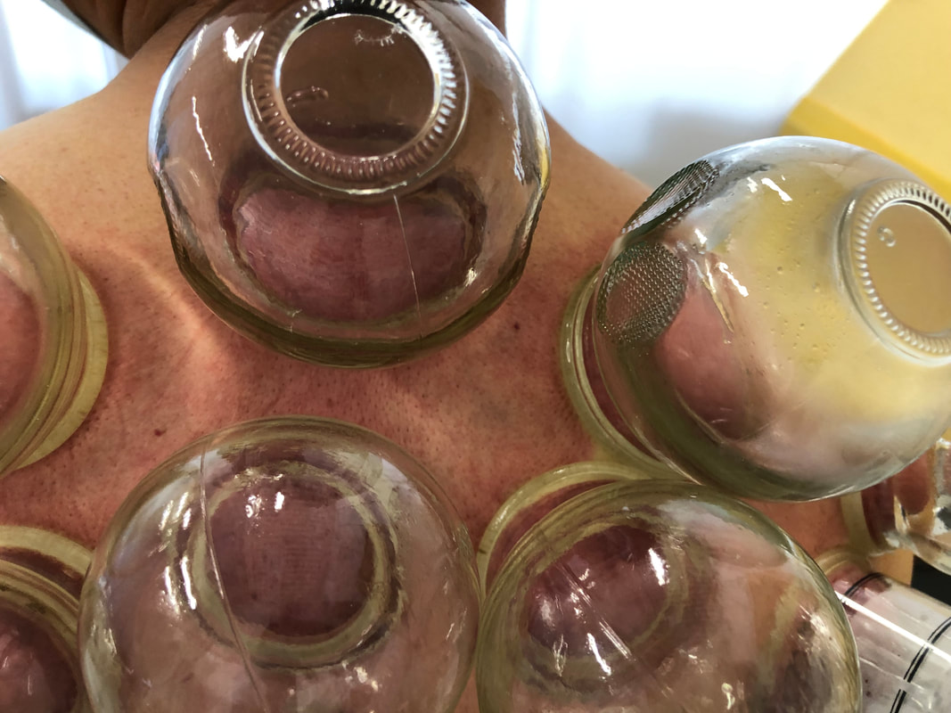 Cupping Therapy Demonstration