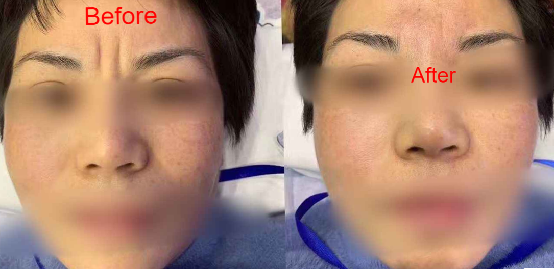 Before and after – forehead lift