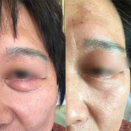 Eye puffiness improvement